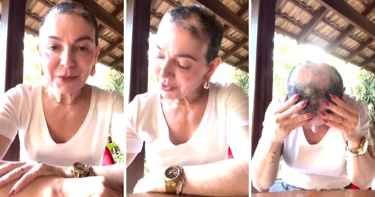 Alopecia areata: custo alto e falta de acesso em Goiás preocupam pacientes