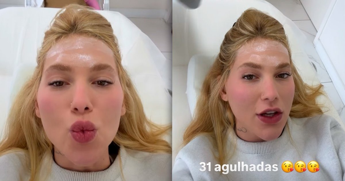 Virginia Fonseca recebe 31 aplicações de botox na cabeça para tratar enxaqueca