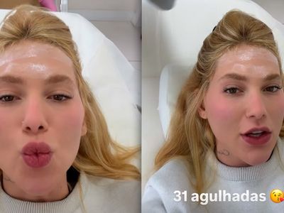 Virginia Fonseca recebe 31 aplicações de botox na cabeça para tratar enxaqueca