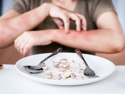 Alergias alimentares causaram quase 500 mortes no Brasil desde 2022